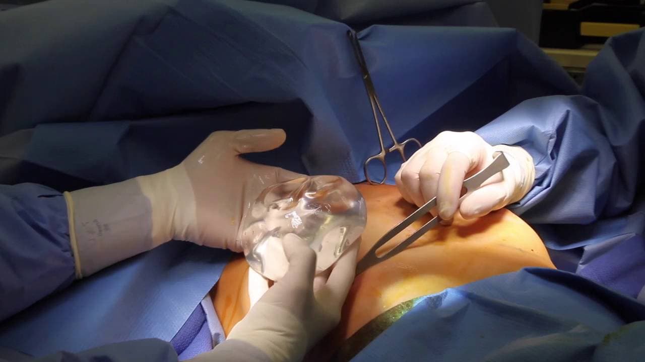 Brustvergrößerung mit Implantaten in Bochum – Ihre Experten für ästhetische Chirurgie