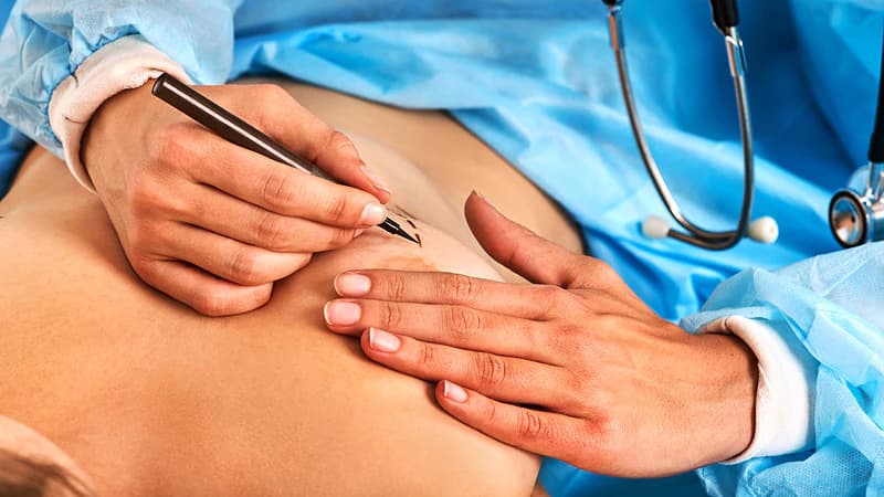 Bauchdeckenstraffung: Was Patienten vor der Operation wissen sollten