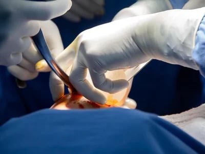 Wie sich die Brustvergrößerung mit Eigenfett im Vergleich zu Implantaten verhält