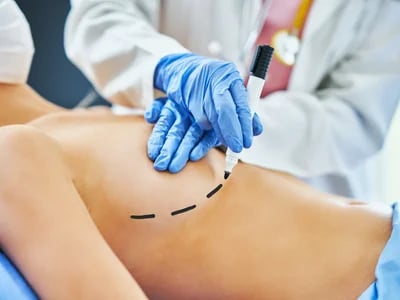 Bauchdeckenstraffung: Was Patienten vor der Operation wissen sollten