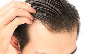 Haartransplantation in der türkei: Erfolgreiche Vorher-Nachher-Ergebnisse enthüllt