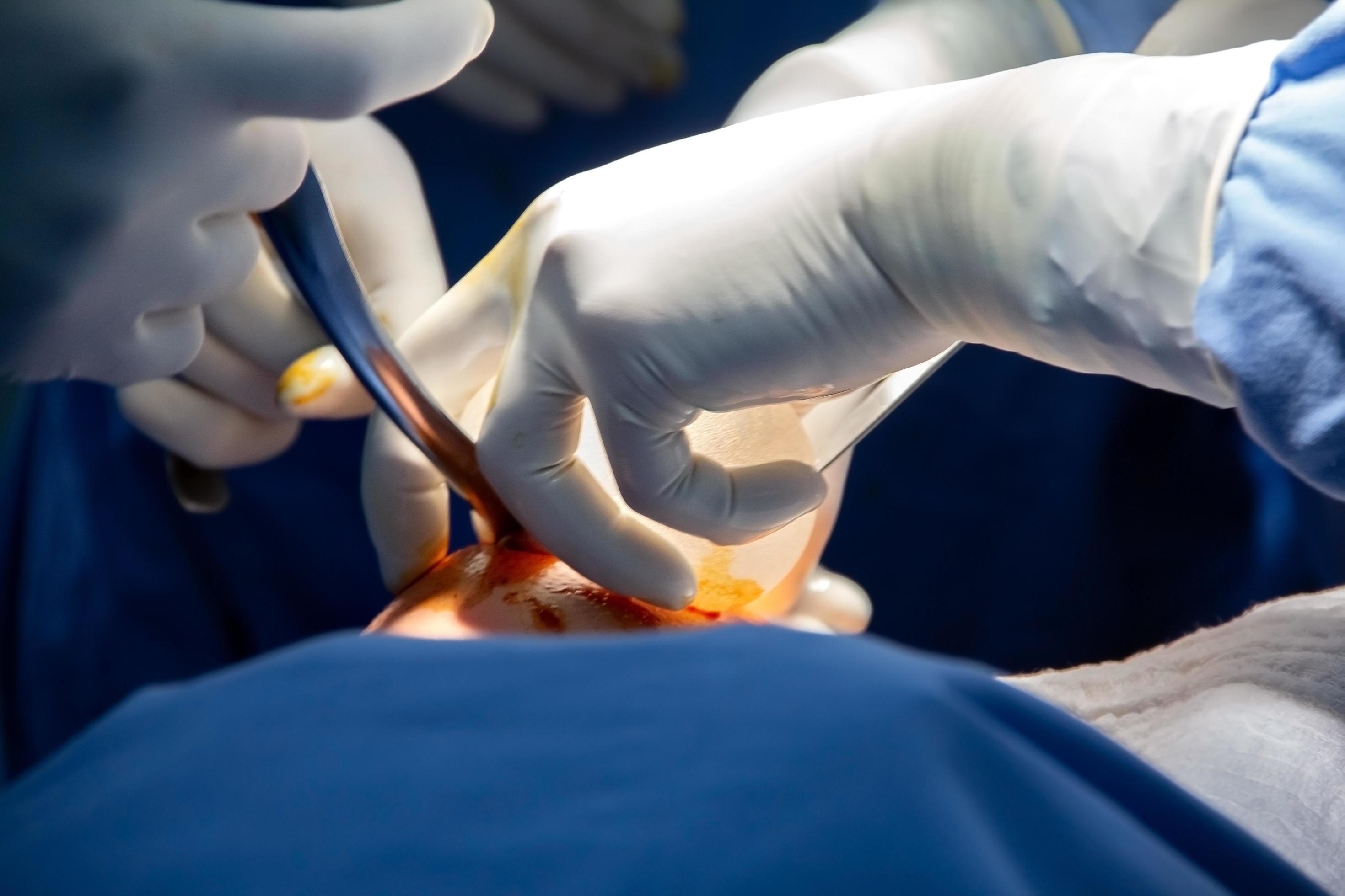 Wie sich die Brustvergrößerung mit Eigenfett im Vergleich zu Implantaten verhält